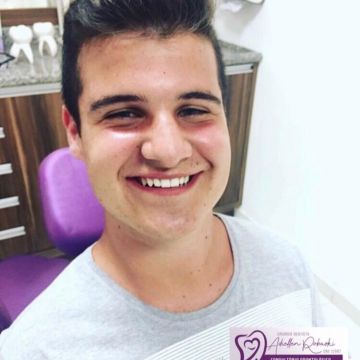 Clareamento dental: o que você precisa saber