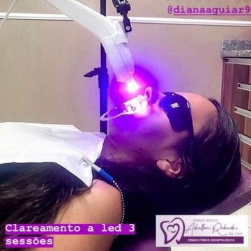 Clareamento dental: o que você precisa saber