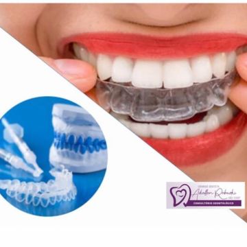 Clareamento dental: o que você precisa saber