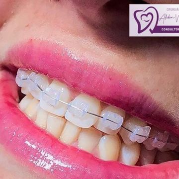 Aparelho ortodôntico: os diferentes modelos e suas funções 