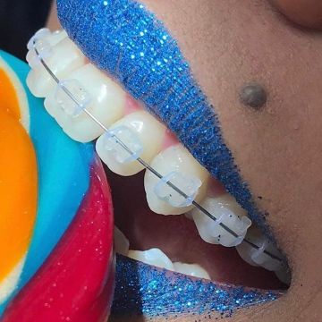 Aparelho ortodôntico: os diferentes modelos e suas funções 