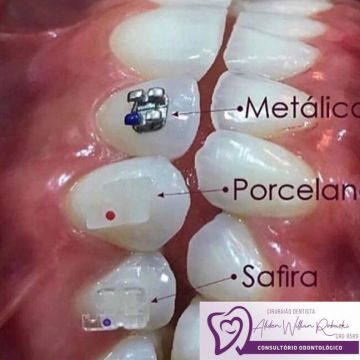 Aparelho ortodôntico: os diferentes modelos e suas funções 