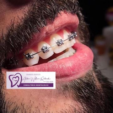 Aparelho ortodôntico: os diferentes modelos e suas funções 
