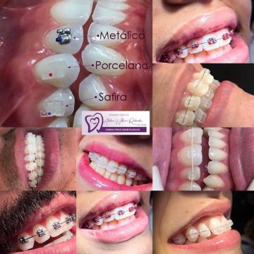 Aparelho ortodôntico: os diferentes modelos e suas funções 