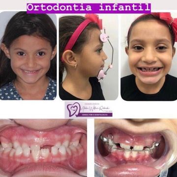 Aparelho ortodôntico: os diferentes modelos e suas funções 