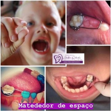 Aparelho ortodôntico: os diferentes modelos e suas funções 