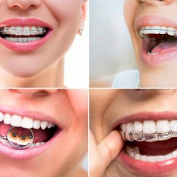 Aparelho ortodôntico: os diferentes modelos e suas funções 