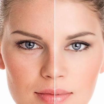 Bichectomia: o segredo para afinar o rosto