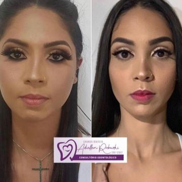 Bichectomia: o segredo para afinar o rosto