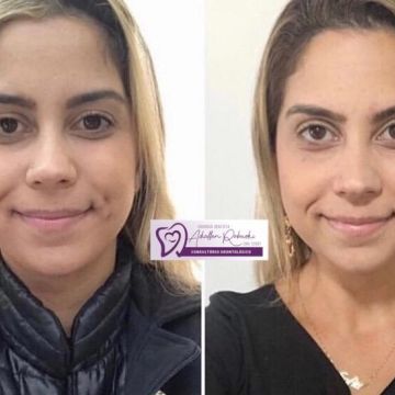 Bichectomia: o segredo para afinar o rosto