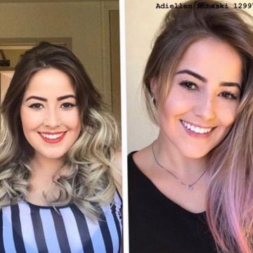 Bichectomia: o segredo para afinar o rosto