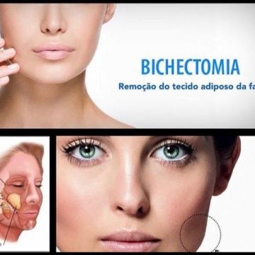 Bichectomia: o segredo para afinar o rosto