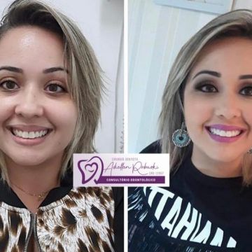 Bichectomia: o segredo para afinar o rosto