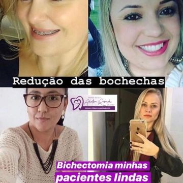 Bichectomia: o segredo para afinar o rosto