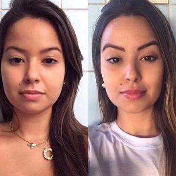 Bichectomia: o segredo para afinar o rosto