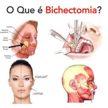 Bichectomia: o segredo para afinar o rosto