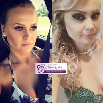 Bichectomia: o segredo para afinar o rosto