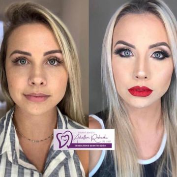 Bichectomia: o segredo para afinar o rosto