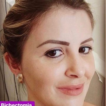 Bichectomia: o segredo para afinar o rosto