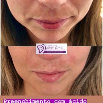 O poder do preenchimento com Ácido Hialurônico para a pele 