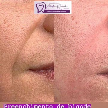 O poder do preenchimento com Ácido Hialurônico para a pele 