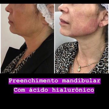 O poder do preenchimento com Ácido Hialurônico para a pele 