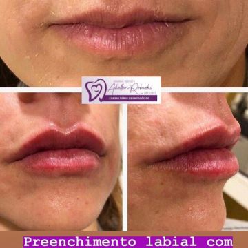 O poder do preenchimento com Ácido Hialurônico para a pele 