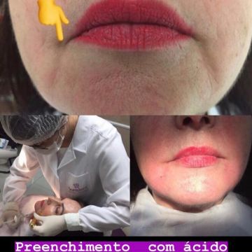 O poder do preenchimento com Ácido Hialurônico para a pele 