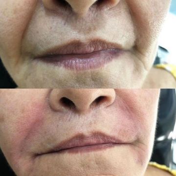 O poder do preenchimento com Ácido Hialurônico para a pele 