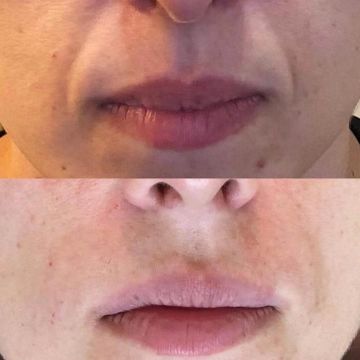 O poder do preenchimento com Ácido Hialurônico para a pele 