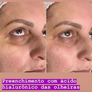 O poder do preenchimento com Ácido Hialurônico para a pele 
