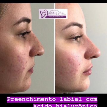 O poder do preenchimento com Ácido Hialurônico para a pele 