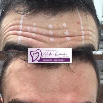Toxina botulínica como age essa substância e quais os seus benefícios para a pele?