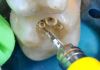 A ozonioterapia na cadeira do dentista?  