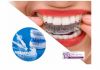 Clareamento dental: o que você precisa saber